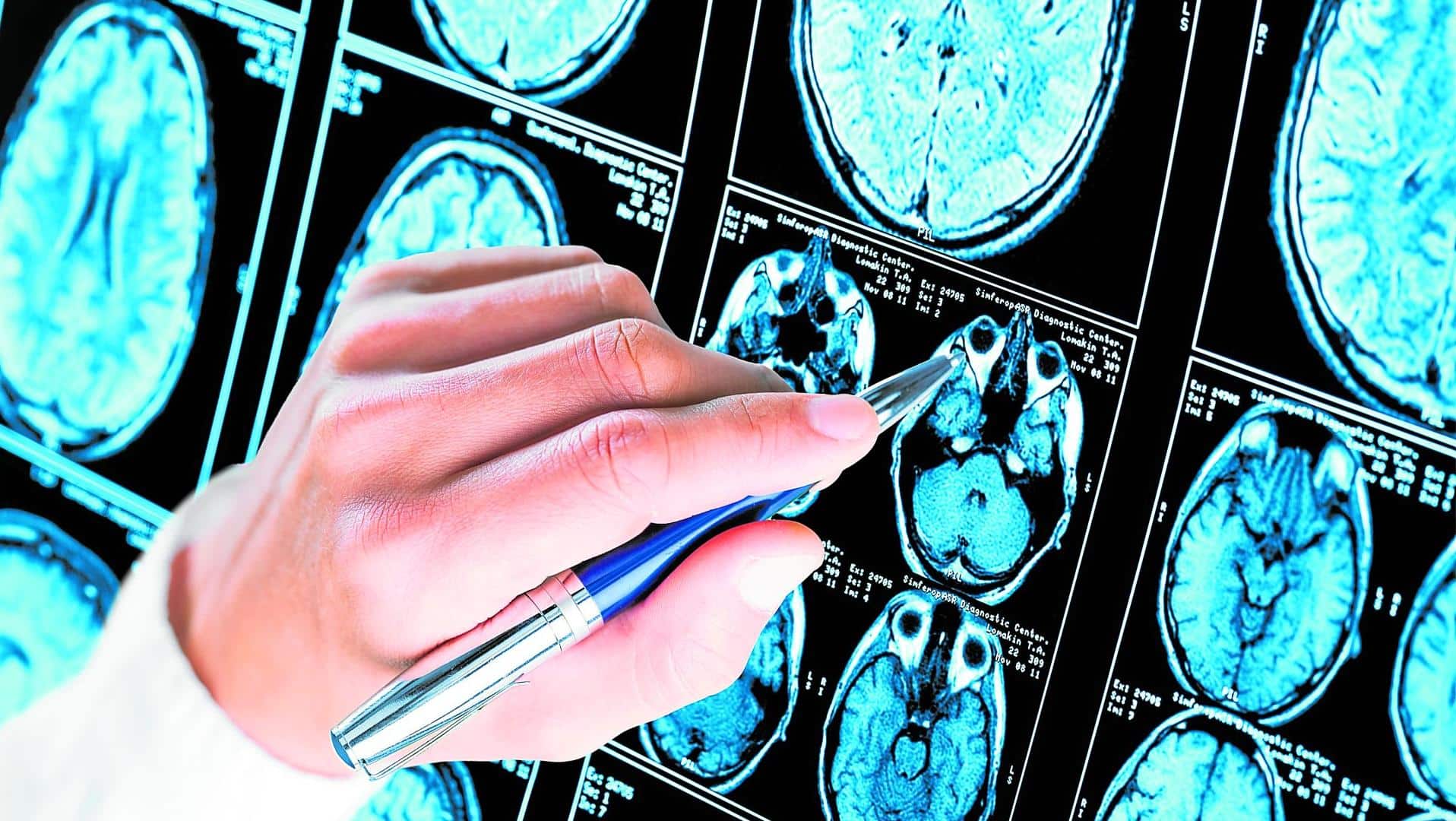 Científicos españoles logran la detección precoz del Alzheimer con un análisis de sangre