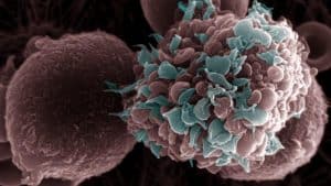 Así favorece la metástasis del cáncer de mama el exceso de grasa