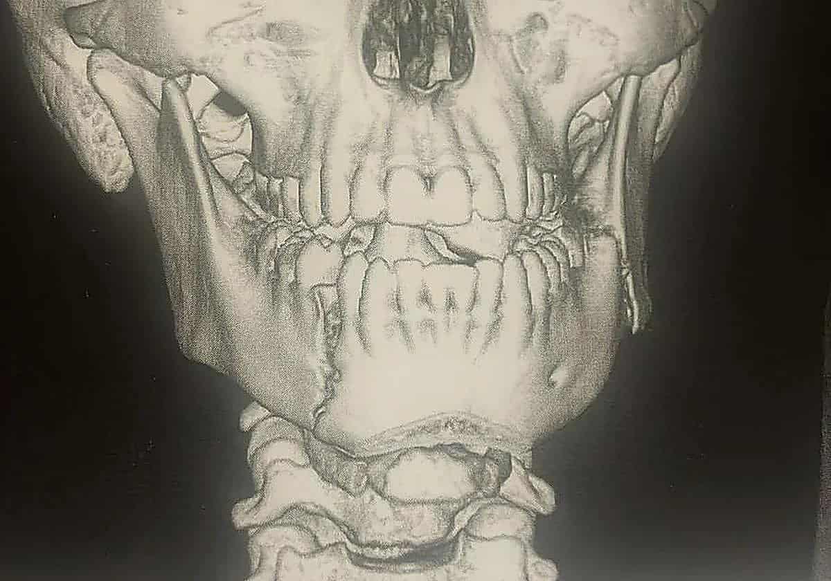 Un menor de 14 años, hospitalizado tras una grave agresión en un instituto de Fuengirola