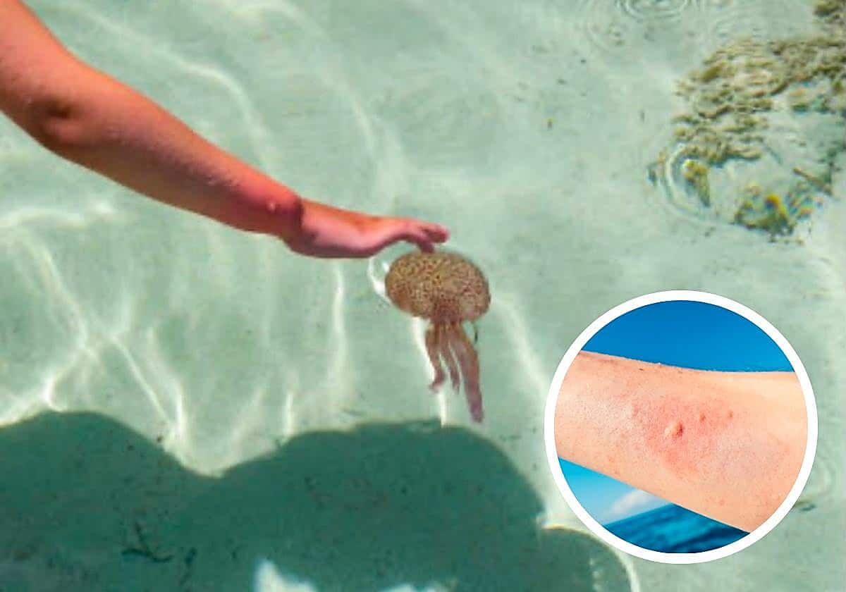 Picaduras de medusa: cuándo dejan de ser una simple molestia y es necesario acudir a urgencias